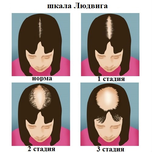 Androgeneticheskaja-alopecija (1)