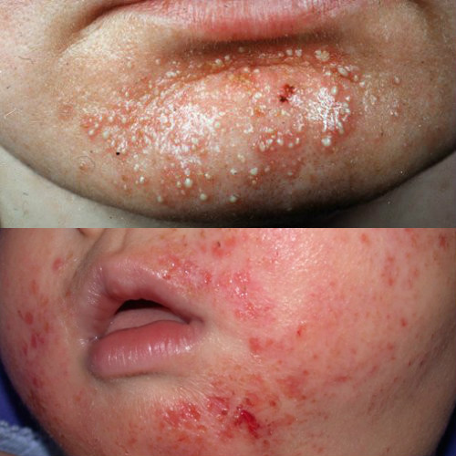 stafilokokkovyj-follikulit (1)