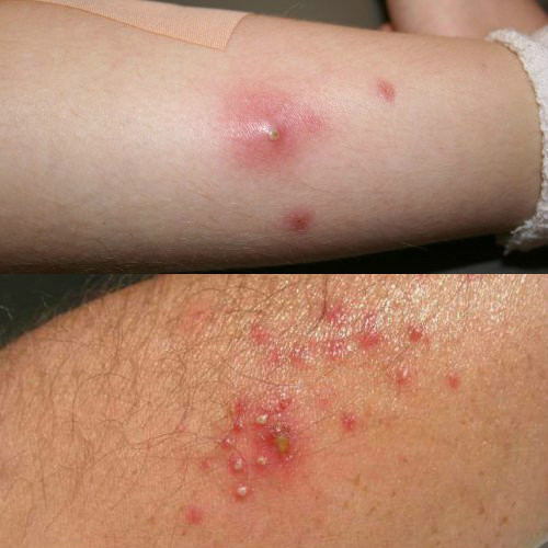 stafilokokkovyj-follikulit (2)